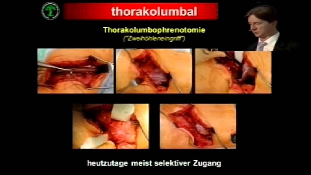 Operative Zugänge zur Hals-, Brust- und Lendenwirbelsäule - dorsal, ventral...