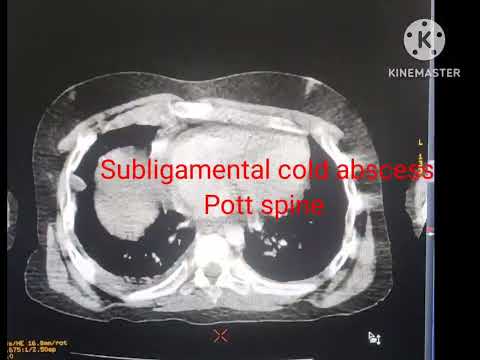 Subligamental cold abscess/ Pott spine