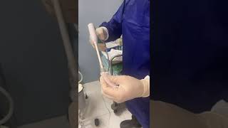 ربط البواسير من دون جراحة Band Ligation of Hemorrhoids without Surgery hemorrhoids piles بواسير