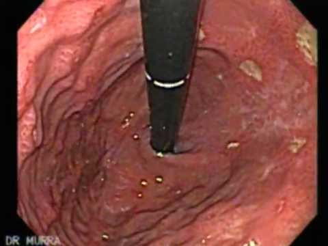 Endoscopy of Multiple Ulcers of the Stomach