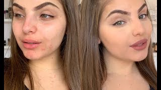 Foundation Routine to Naturally Cover Acne