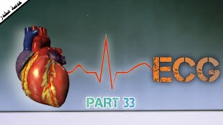 النظم البطيني الذاتي في ECG |تخطيط القلب الكهربائي