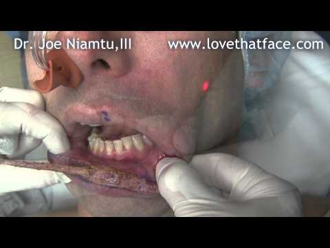 Video: Lip Reduction Kirurgisk Procedure, Bivirkninger, Effektivitet, Omkostninger