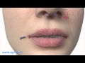 New Aptos Light Lift Vitis - корректировка губ и морщины верхней губы
