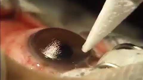 Cách chữa tật khúc xạ mắt