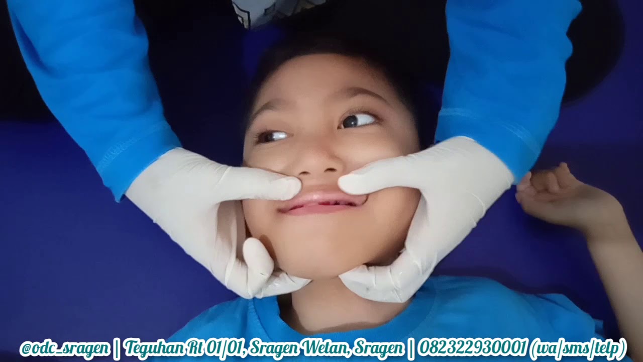 Mengurangi Kekakuan dan Meningkatkan Kemampuan Otot Makan dan Bicara pada Anak CP | TERAPI WICARA