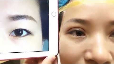 Tiếp Cận Nếp Mí Sau Khi Vừa Cắt Mí Mani Open Deep 5D Tại Dr.Hải Lê.