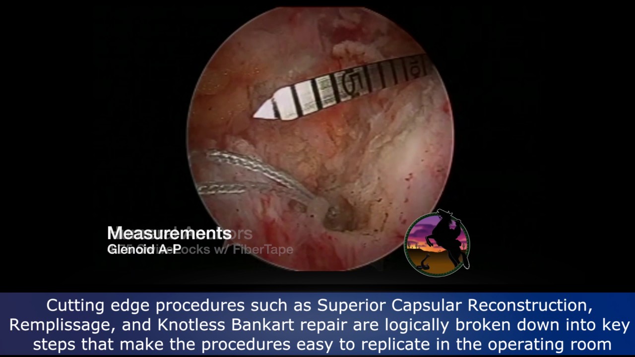 The Cowboy’s Conundrum: Complex and Advanced Cases in Shoulder Arthroscopy