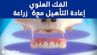 الفك العلوي - إعادة التأهيل مع 6  زراعة الأسنان ©