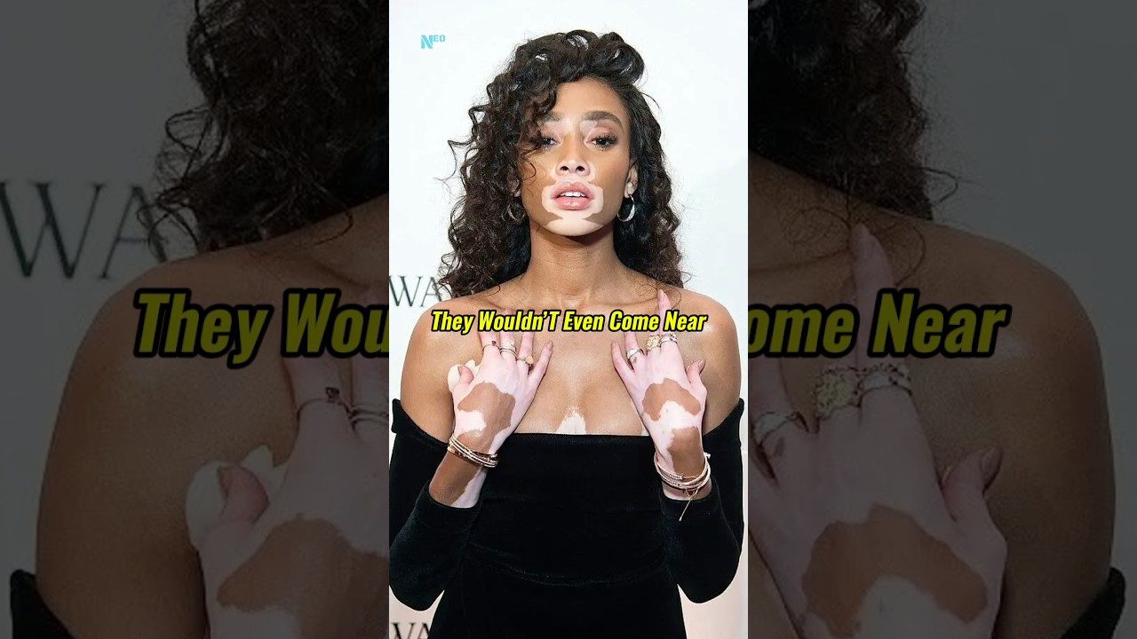 People Were Afraid of Her! Winnie Harlow Story