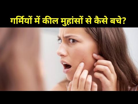 गर्मियों में कील - मुंहासों से हैं परेशान? तो अपनाएं ये टिप्स | कील मुहांसों से छुटकारा कैसे पाएं |