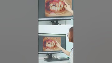 Bác sĩ tư vấn ca niềng răng khó | Lạc Việt Intech Niềng Răng #shorts