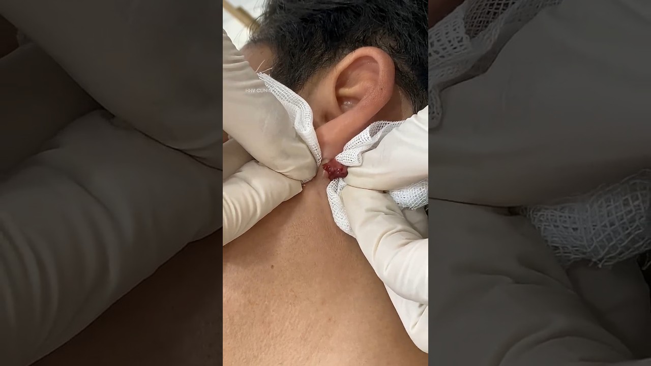 Nặn mụn nhọt sưng như trứng cút ở tai.