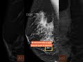 AI Beats Radiologists? Shocking Study on Breast Cancer Detection