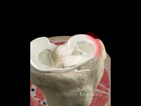 Meniscus Bucket Handle Tear