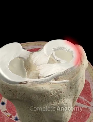Meniscus Bucket Handle Tear