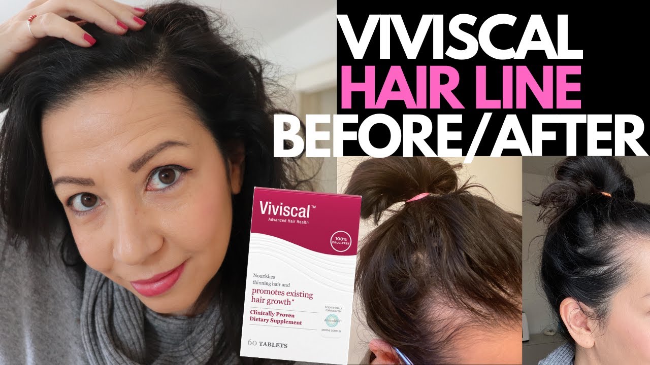 YES, VIVISCAL SUPPLEMENTS WORKED! Hair Loss Sufferer's 3 Month Hair Regrowth  Experience BEFORE/AFTER - thptnganamst.edu.vn