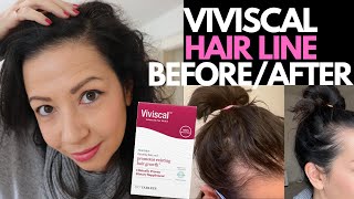 YES, VIVISCAL SUPPLEMENTS WORKED! Hair Loss Sufferer's 3 Month Hair Regrowth Experience BEFORE/AFTER