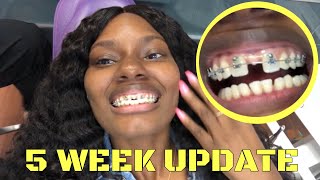 5 Week Braces Update... Closing My Gap | StarringShameka