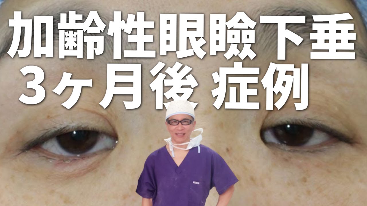 加齢性眼瞼下垂の症例解説／手術後 3か月　名古屋こいずみ形成クリニック