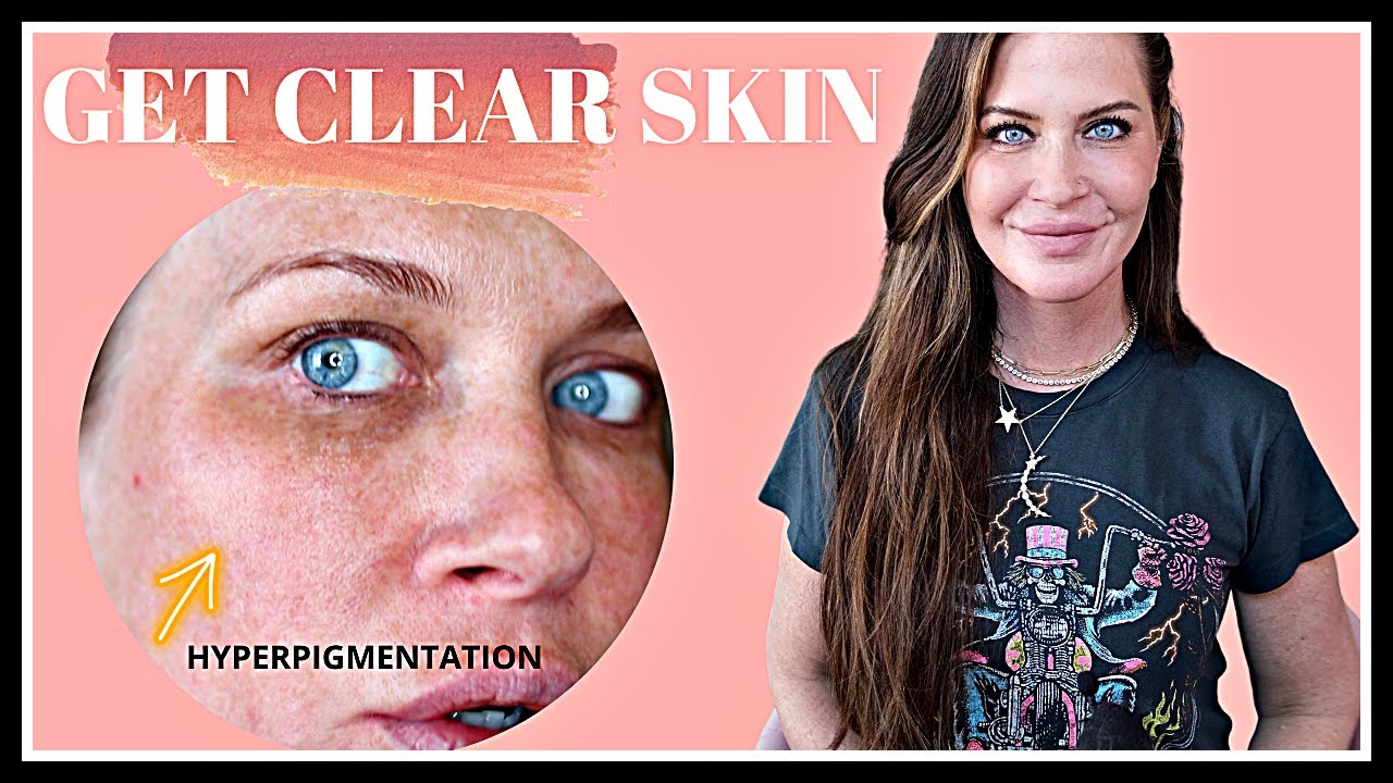 HOW TO CLEAR BROWN SPOTS | EXACTLY WHAT YOU NEED TO GET BRIGHT, CLEAR SKIN!