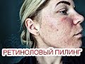 РЕТИНОЛОВЫЙ ПИЛИНГ ЛИЦА, МОЙ ОПЫТ