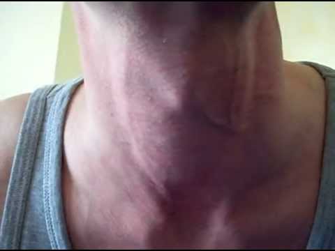 Visible Carotid Pulse In Neck Visible Carotid Pulse In Neck