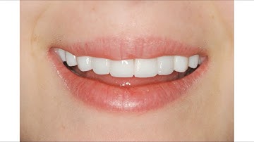 PALTOP- Surgical & Restorative Reconstruction Using a Digital Workflow