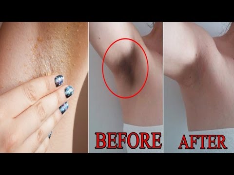 Baking Soda For Dark Spots & Acne Scars :: How to Remove & Fade Away :: DIY