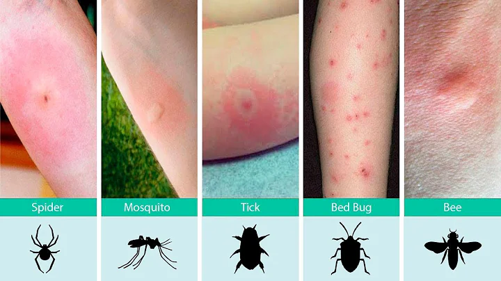 Ouch, What Bit Me? How to Identify Common Bug Bites and What To Do About It - DayDayNews