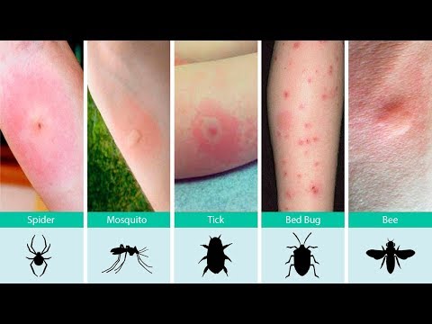 فيديو: هل يجب علي خدش لدغات الحشرات؟