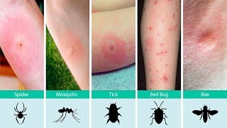 Ouch, What Bit Me? How to Identify Common Bug Bites and What To Do About It