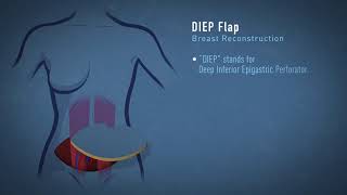 DIEP Flap Breast Reconstruction Animation