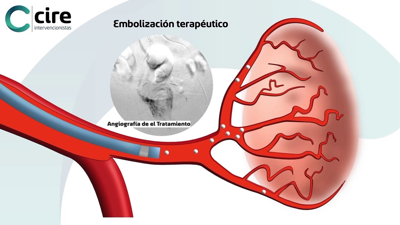 hipertrofia de la hidroablación con láser de próstatas