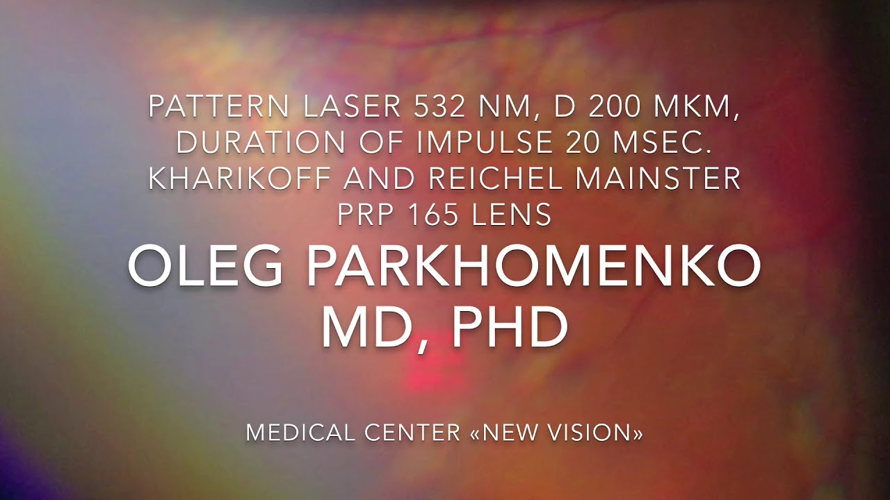 Barrier laser coagulation in local Retinal detachment