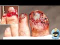 WORST TOE INJURY EVER?! ***HIS TOE WAS SPLIT IN HALF!!!***