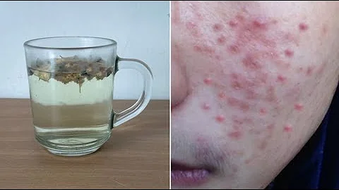 脸长痘痘粉刺？用它泡水喝，脸上痘痘、粉刺和暗疮竟消失了！皮肤变得光滑不再长痘痘！ - 天天要闻