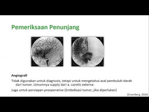 Video: Di manakah meningioma biasa ditemui?