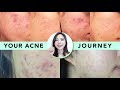 🌴How My Subscribers Cleared Up Acne • Skincare & Diet Tips to Get Rid of Acne