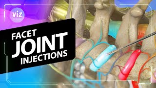 Neck Pain That Won’t Quit? This Could Help (3D Animation)