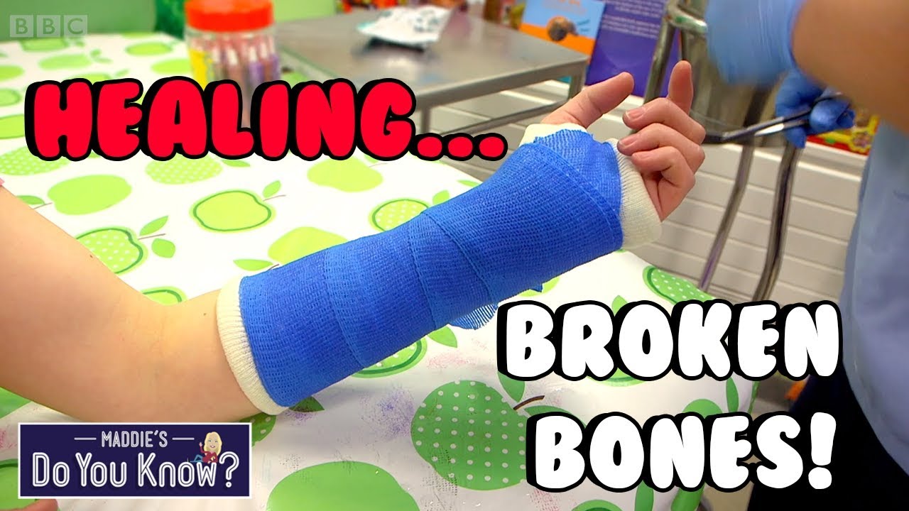 Cast For a Broke Bone: What Is It Made Of?