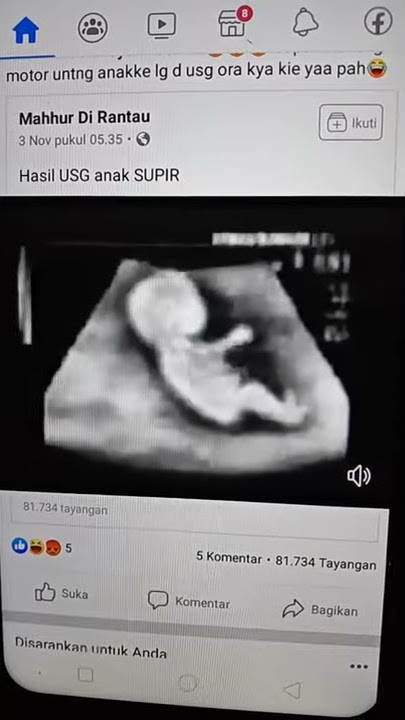 Hasil USG anak supir