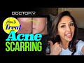 Doctor V - How To Treat Acne Scarring | Skin Of Colour | Brown Or Black Skin