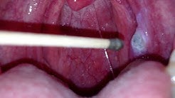 silver nitrate 'burning' of a canker sore 
