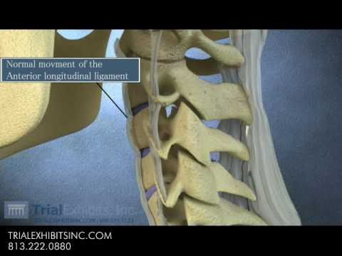 Anterior Subluxation in the Cervical Spine - 3D Animation