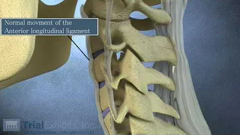 Anterior Subluxation in the Cervical Spine - 3D Animation