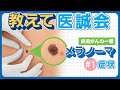 【教えて医誠会】シミ？ほくろ？…悪性度の高い皮膚がん『メラノーマ』の症状とは？