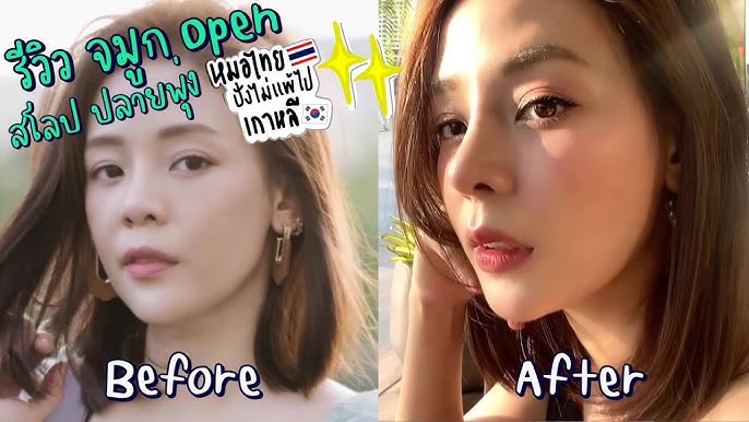 I Got A Nose Job In Korea! Best Decision Ever! | Vlog & In-Depth Review  (Full Experience) - Youtube