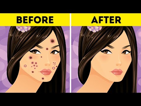 How To Remove Blackheads At Home: A Guide to Eliminating Blackheads