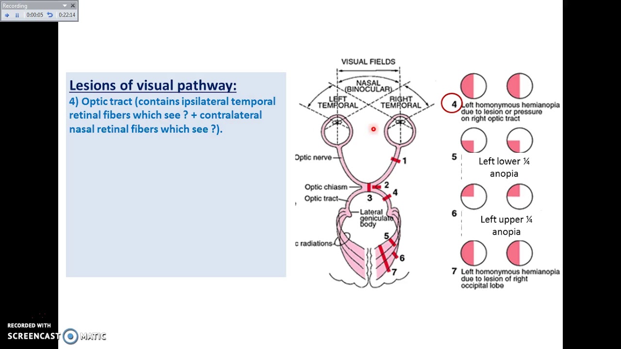 Lesions of the Visual Pathway YouTube